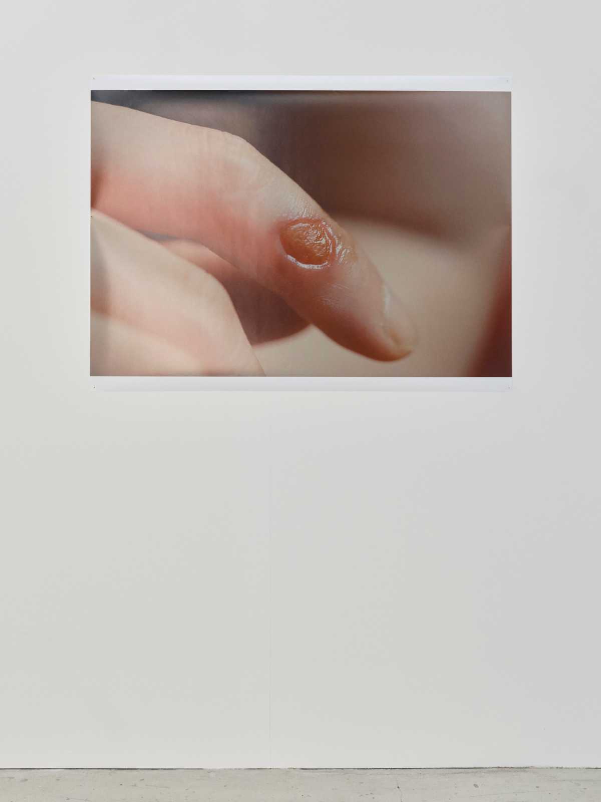 Wound